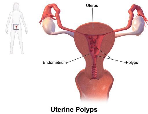 uterine endometrial polyp