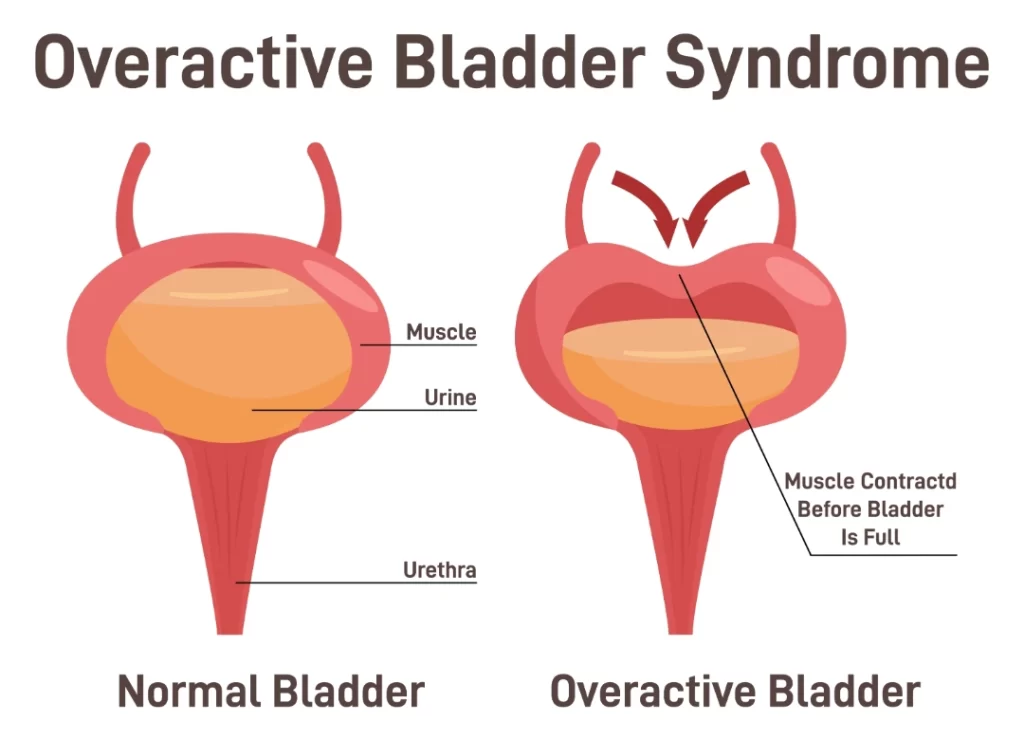 Overactive Bladder in Singapore - Dr Ng Kai Lyn