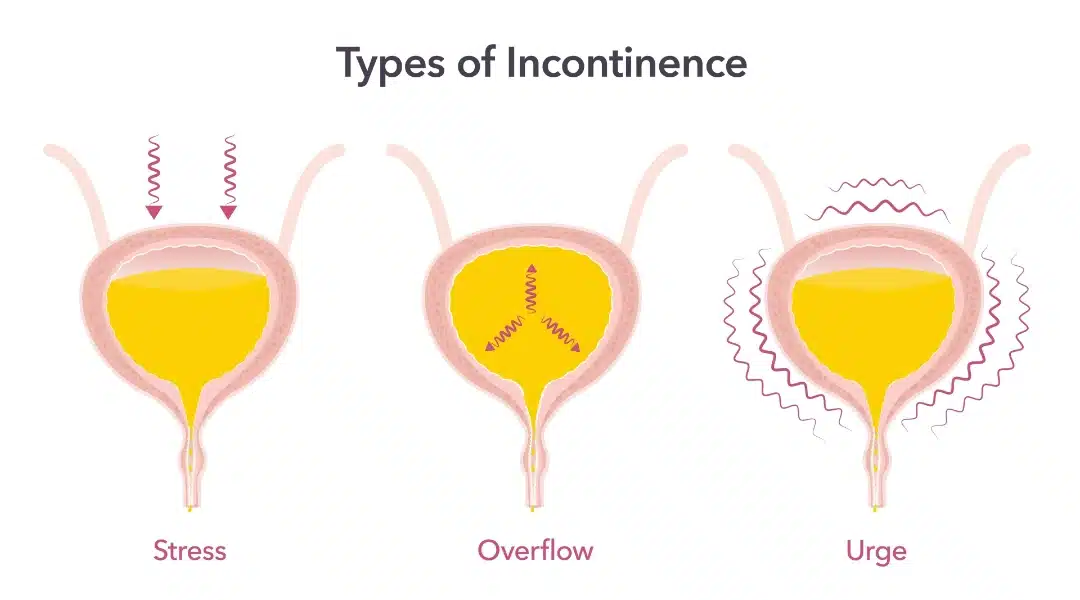 urine incontinence