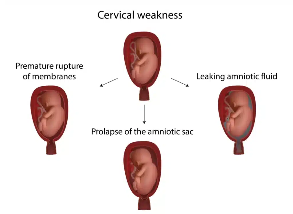 cervical weakness