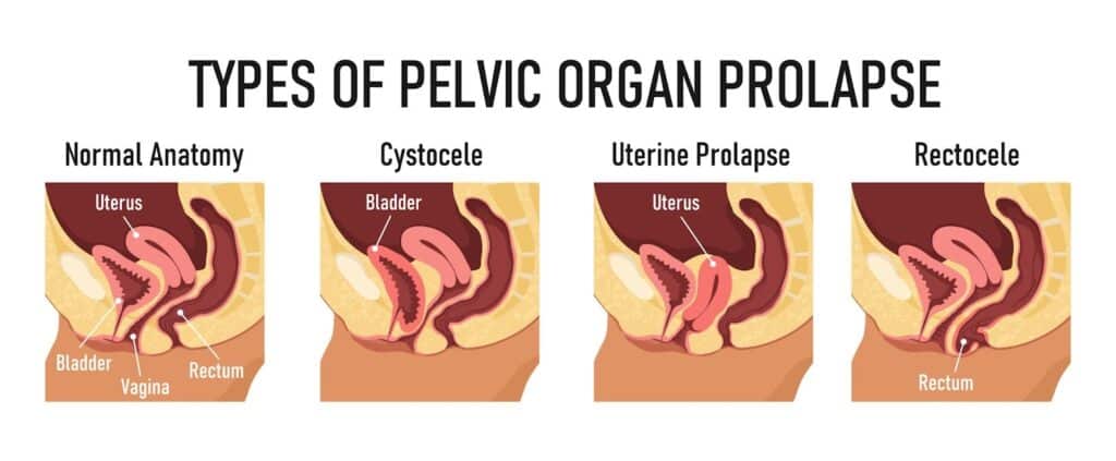 pelvic organ prolapse types