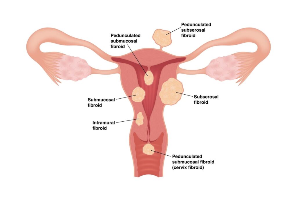 uterine fibroids types singapore