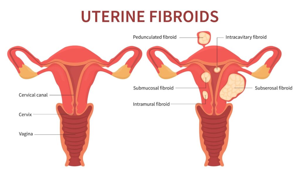 uterine fibroids singapore