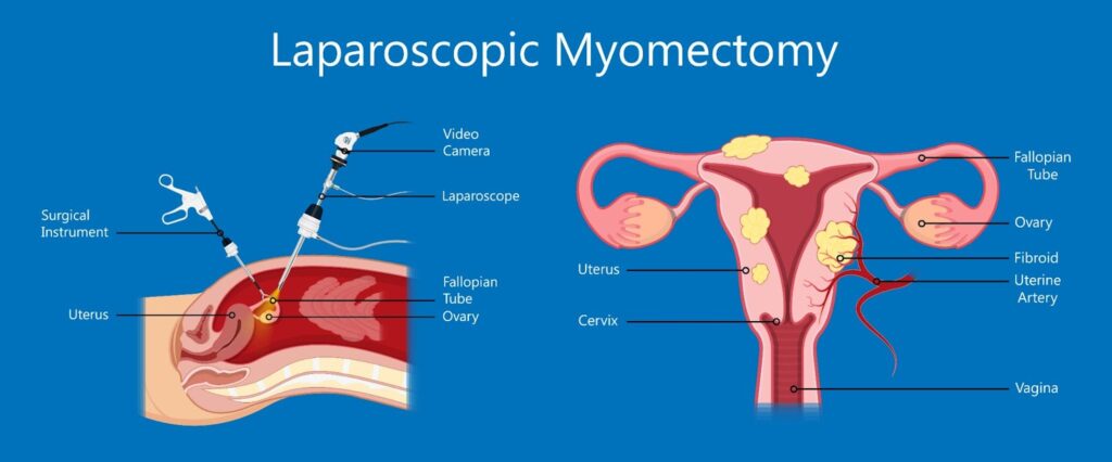 Laparoscopic myomectomy singapore