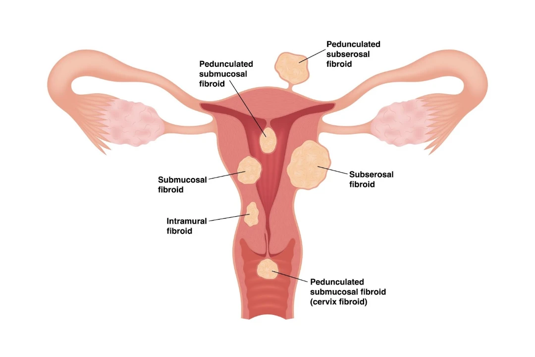 uterine fibroids types singapore