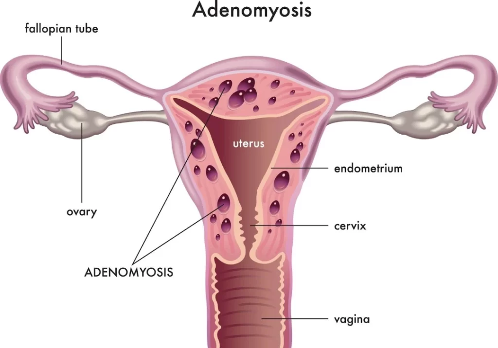 adenomyosis singapore