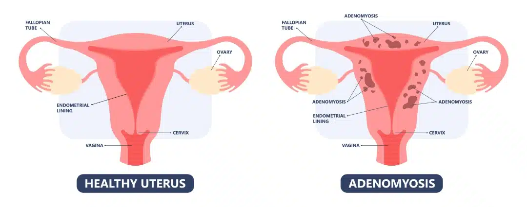 adenomyosis