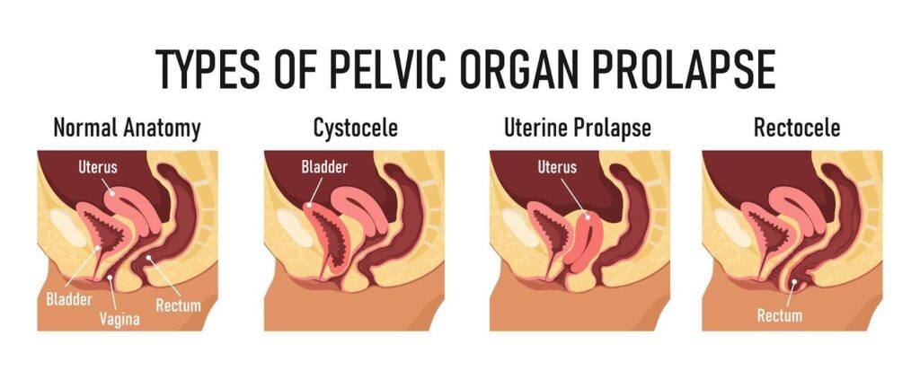 pelvic organ prolapse singapore