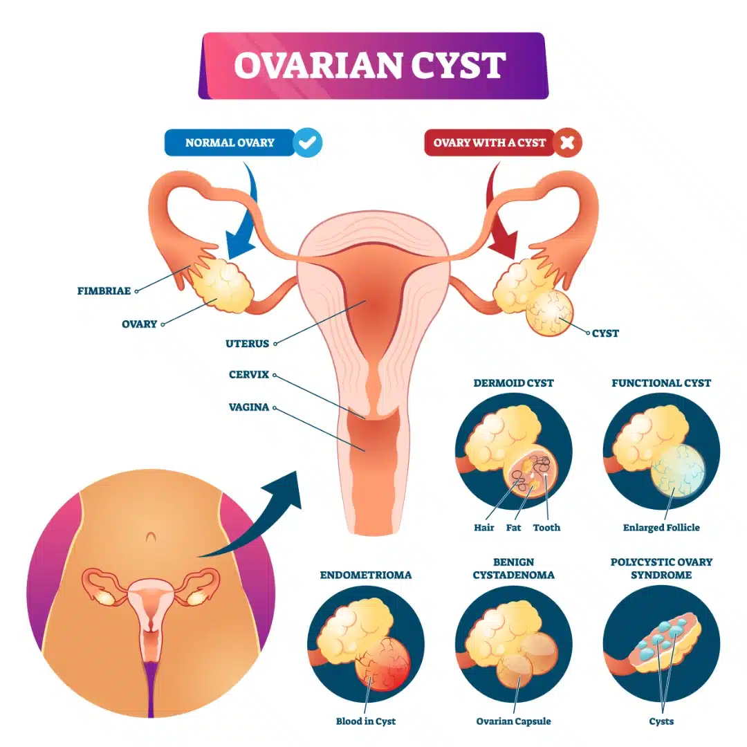 ovarian cysts