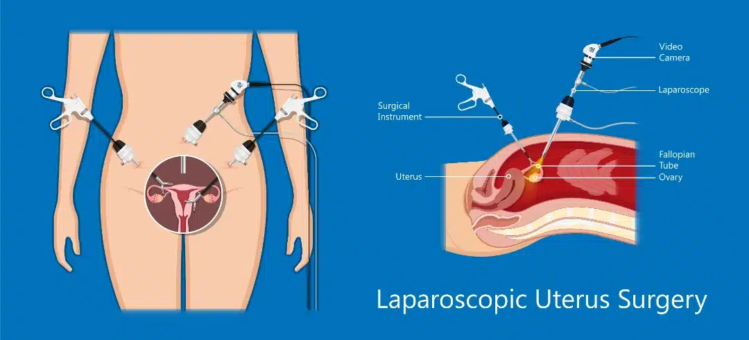 laparoscopy