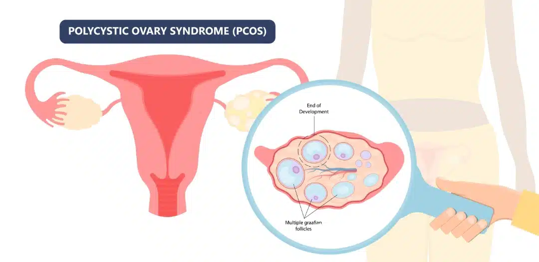 PCOS