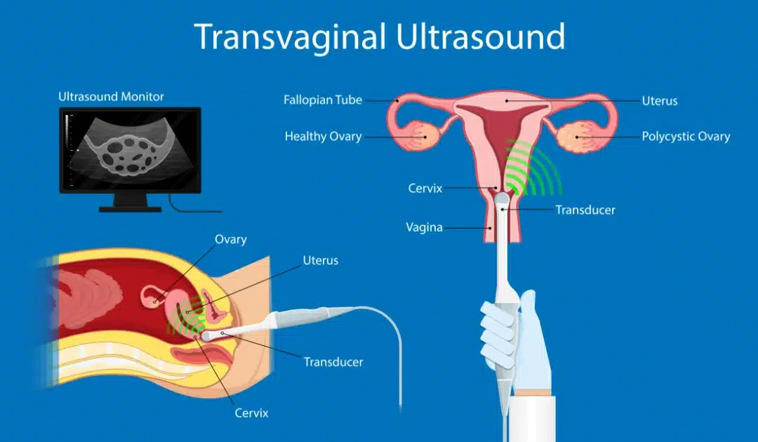 ultrasound PCOS