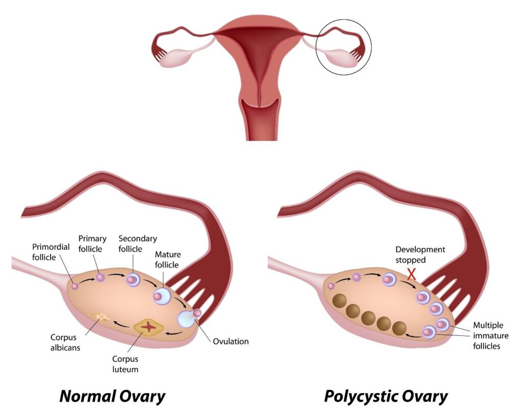 pcos Singapore.