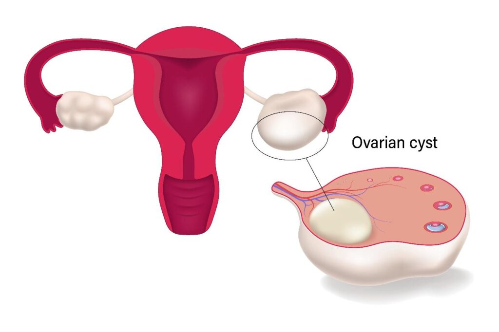 ovarian cysts pcos.