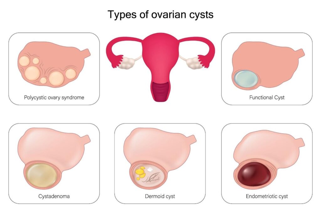 Types of Ovarian Cysts Singapore